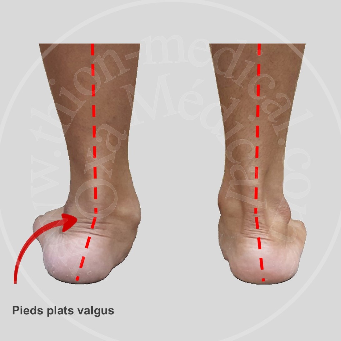 Photo de pieds plats valgus